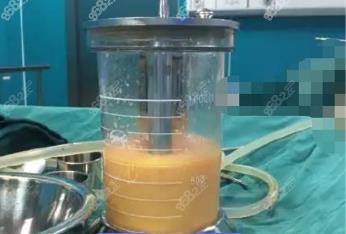 佳木斯360度水动力吸脂费用多少钱？