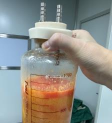 佳木斯水动力吸脂手术要做多久？